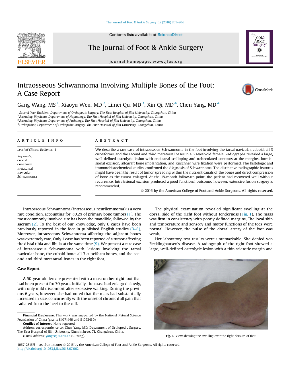 Intraosseous Schwannoma Involving Multiple Bones of the Foot: A Case Report 