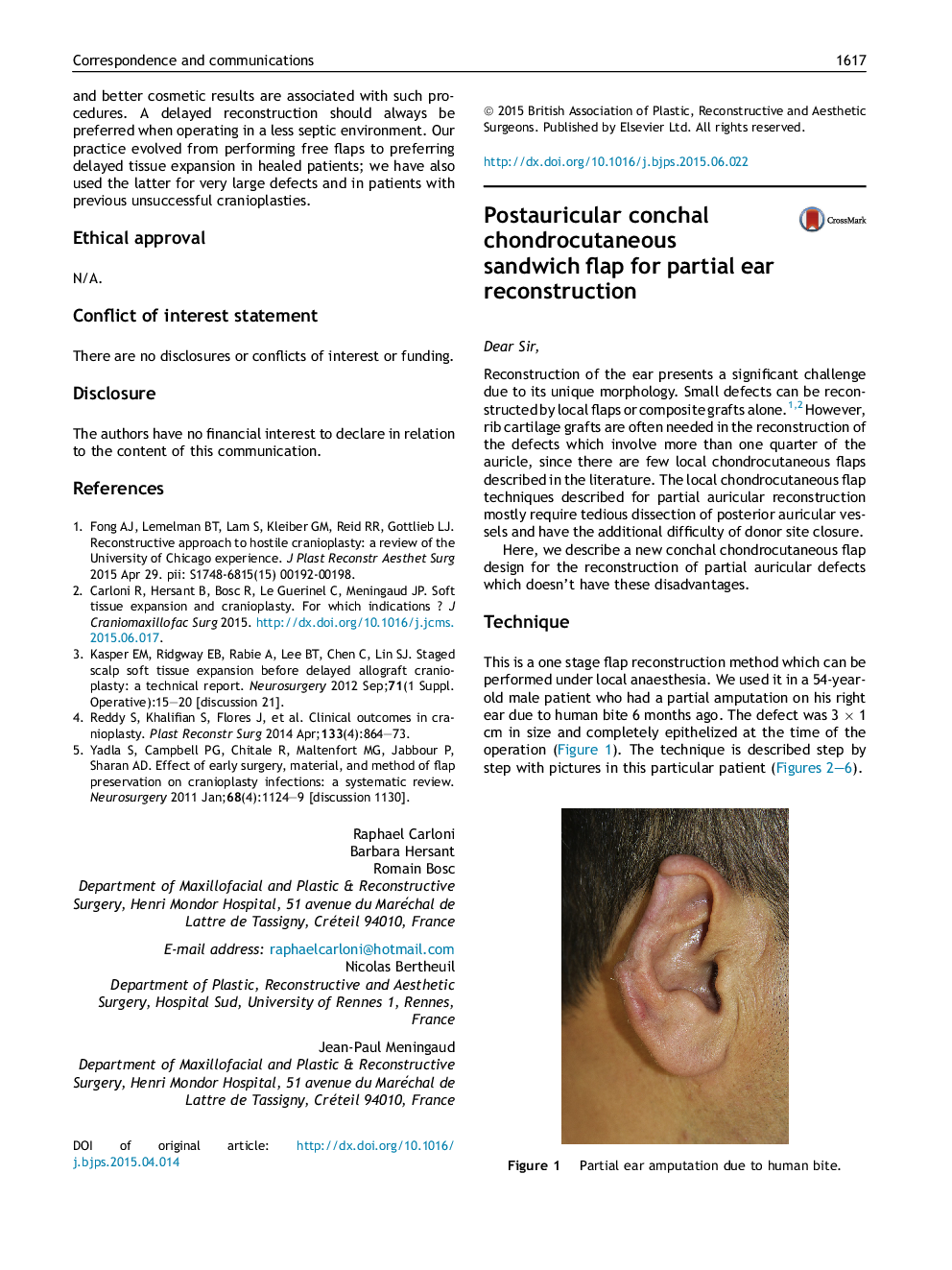 Postauricular conchal chondrocutaneous sandwich flap for partial ear reconstruction
