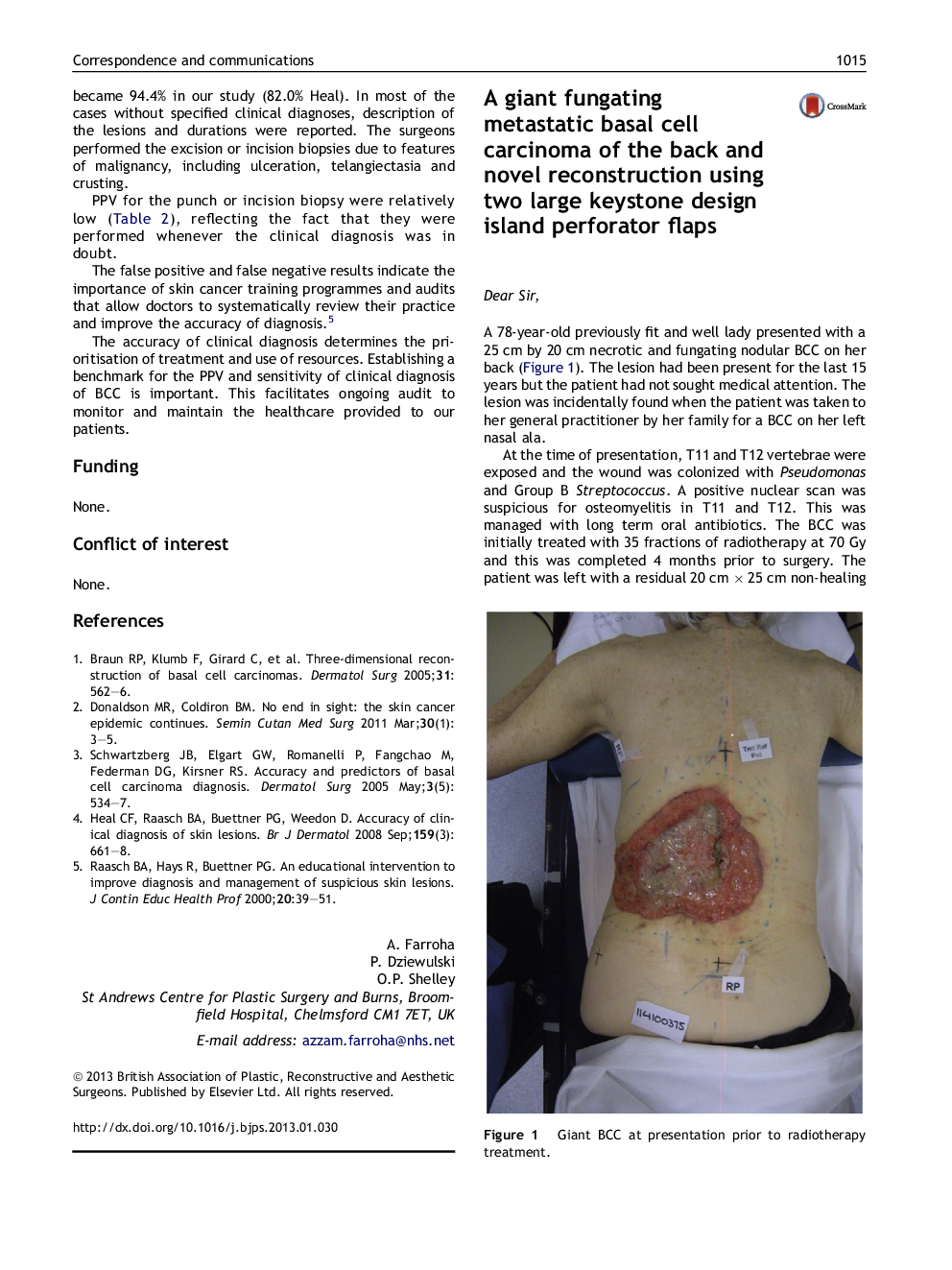 A giant fungating metastatic basal cell carcinoma of the back and novel reconstruction using two large keystone design island perforator flaps