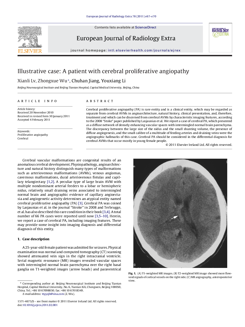 Illustrative case: A patient with cerebral proliferative angiopathy