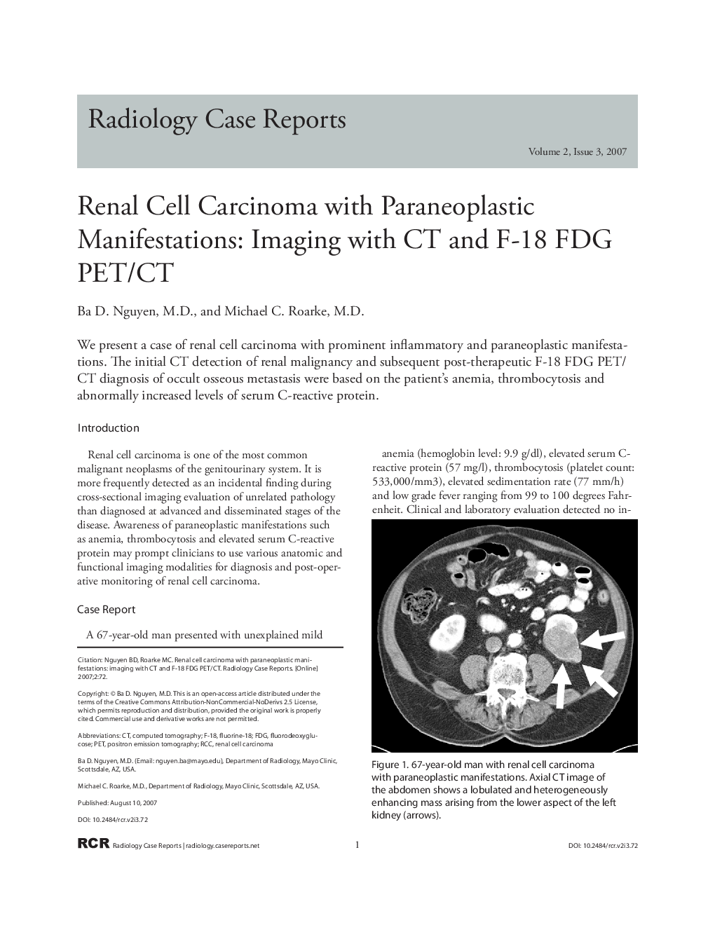 Renal Cell Carcinoma with Paraneoplastic Manifestations: Imaging with CT and F-18 FDG PET/CT
