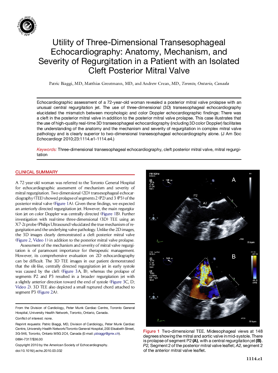 Utility of Three-Dimensional Transesophageal Echocardiography: Anatomy, Mechanism, and Severity of Regurgitation in a Patient with an Isolated Cleft Posterior Mitral Valve