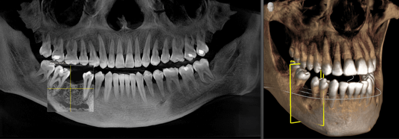 تصویربرداری سه بعدی از دندان