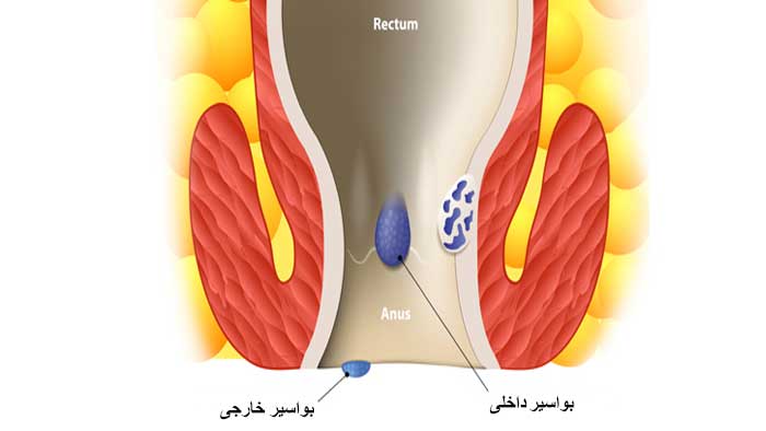 انواع هموروئید