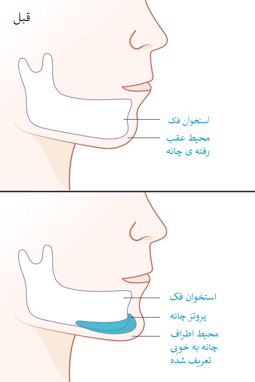 قبل و بعد از عمل پروتز چانه