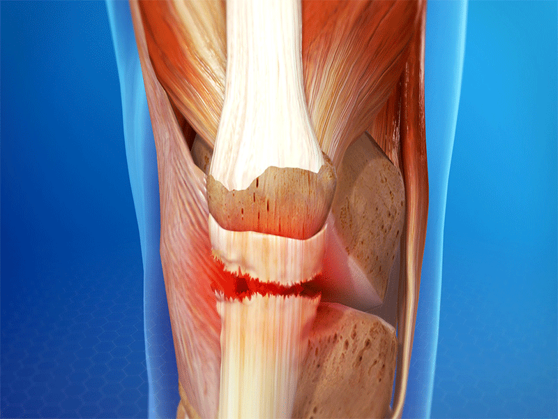 عمل پارگی تاندون زانو/ درمان پارگی تاندون زانو با عمل جراحی
