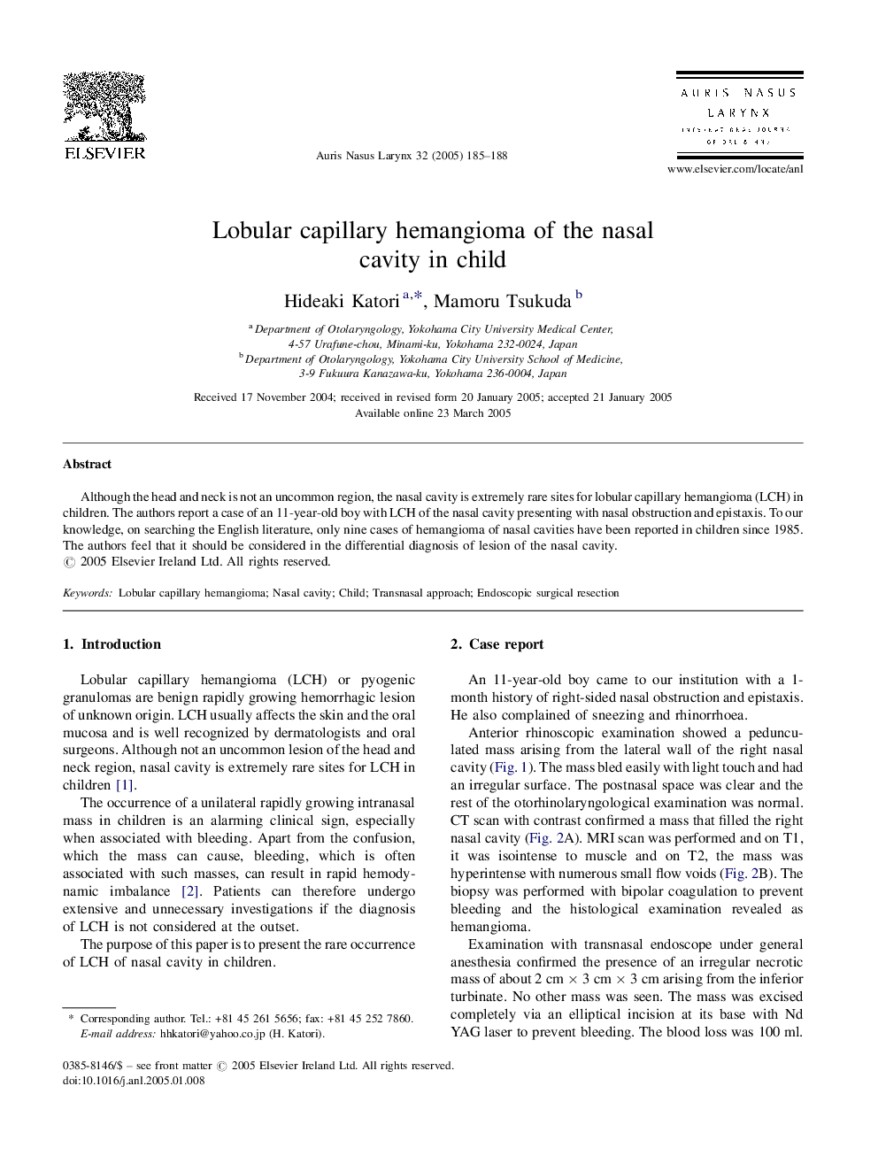 Lobular capillary hemangioma of the nasal cavity in child