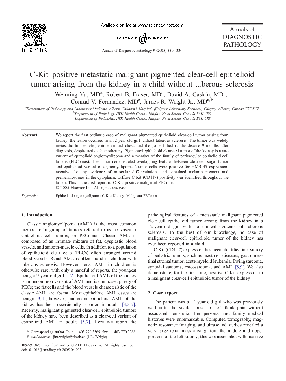 C-Kit-positive metastatic malignant pigmented clear-cell epithelioid tumor arising from the kidney in a child without tuberous sclerosis