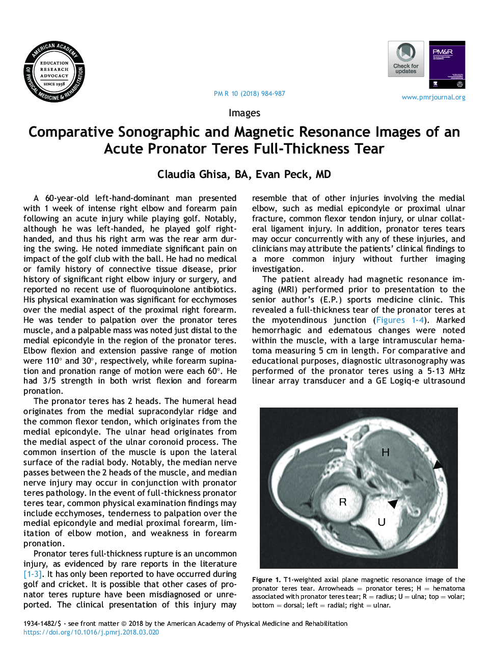 Comparative Sonographic and Magnetic Resonance Images of an Acute Pronator Teres Full-Thickness Tear