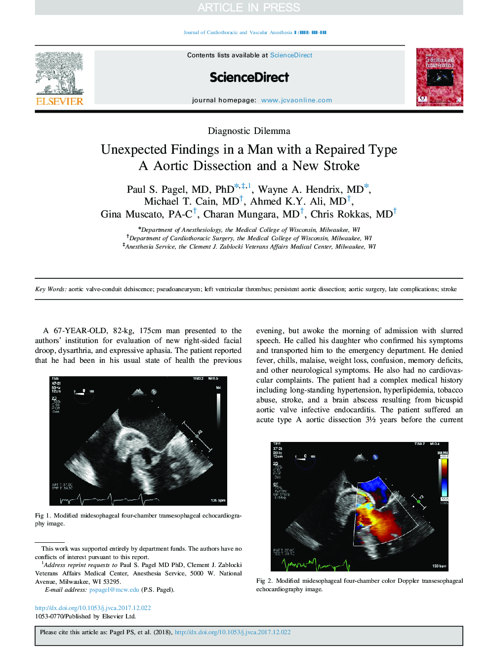 Unexpected Findings in a Man with a Repaired Type A Aortic Dissection and a New Stroke