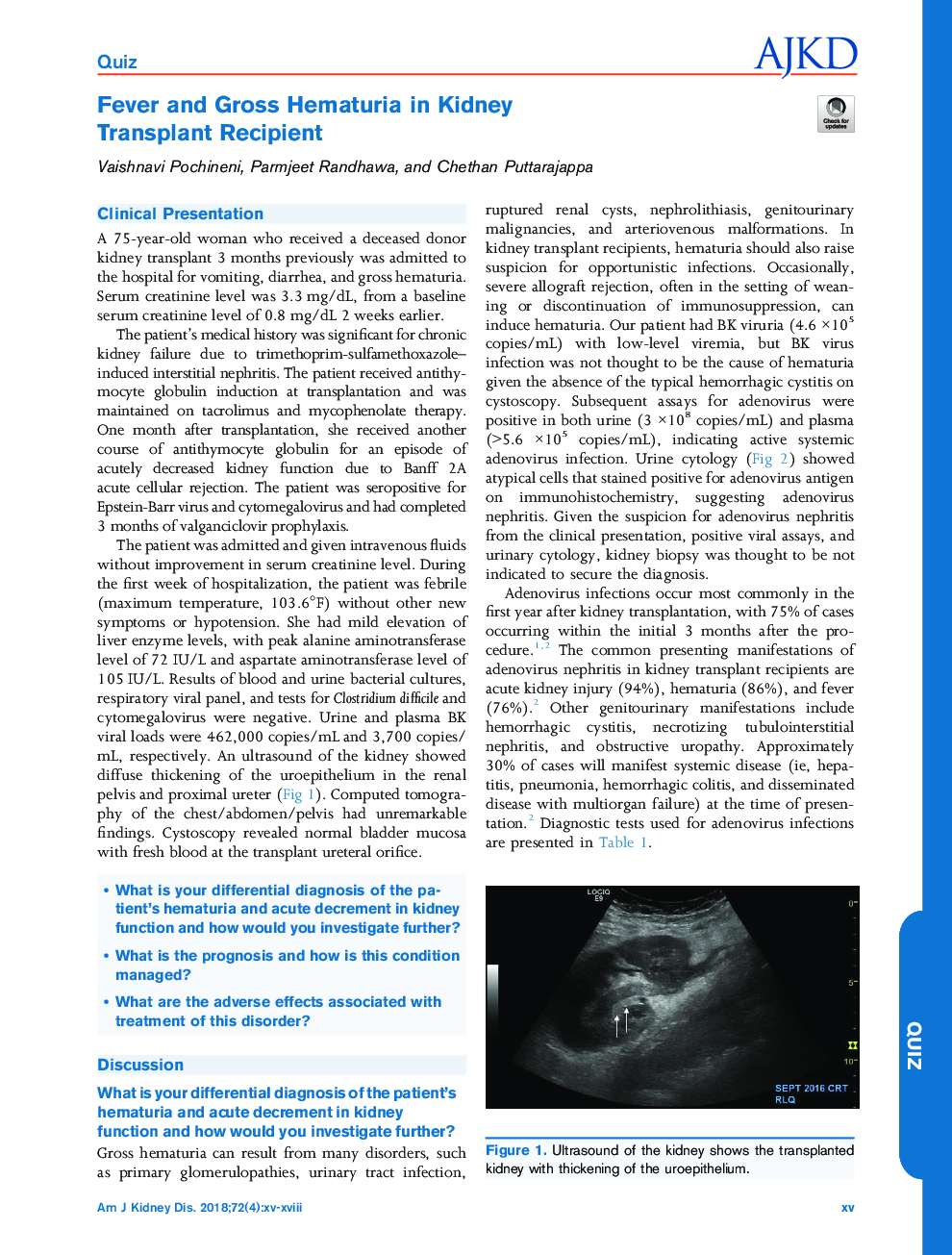 Fever and Gross Hematuria in Kidney TransplantÂ Recipient