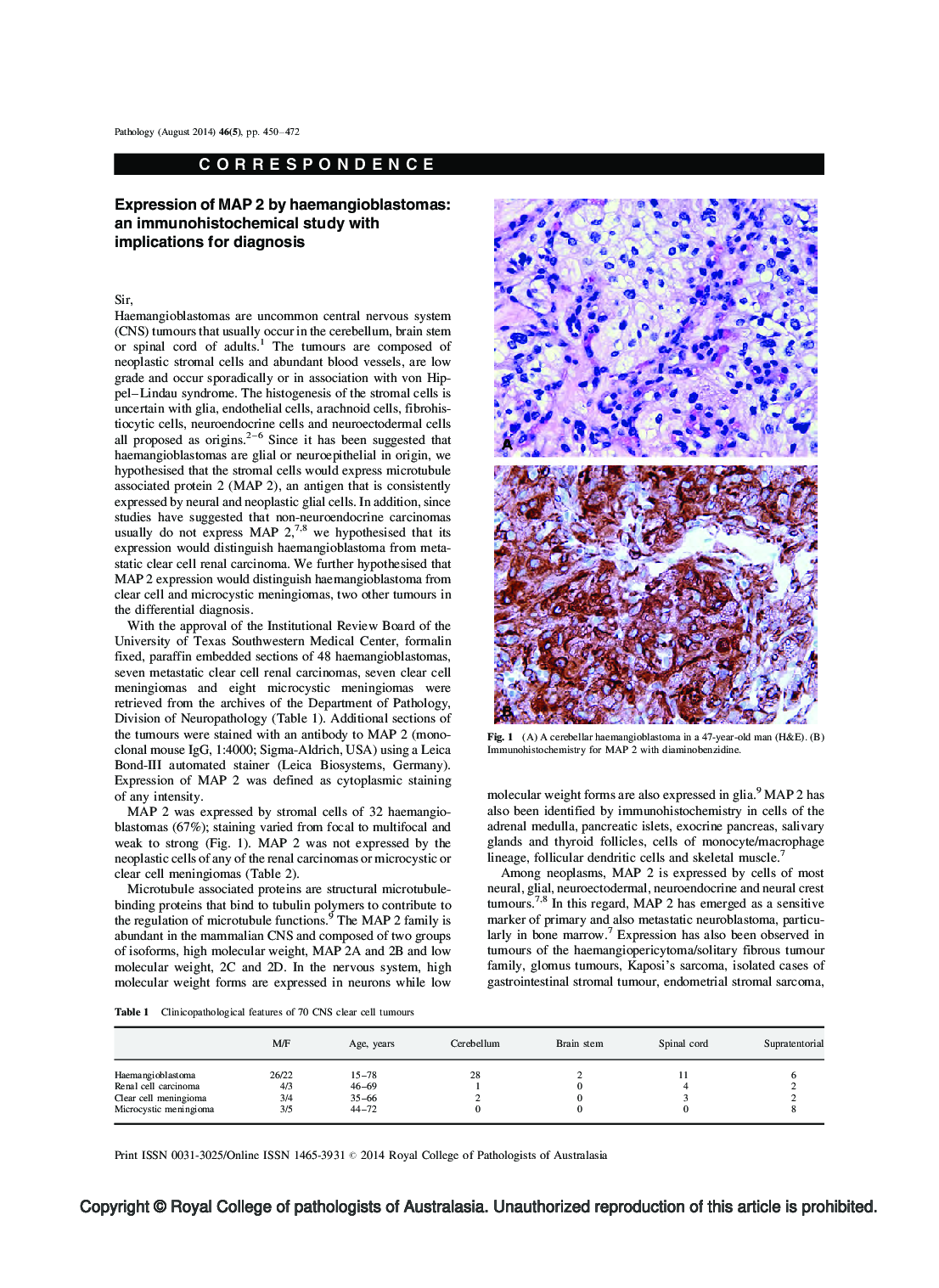 تومور سلول های اسپیندل اولیه هیپولیزین ریه با روت های غول پیکر 