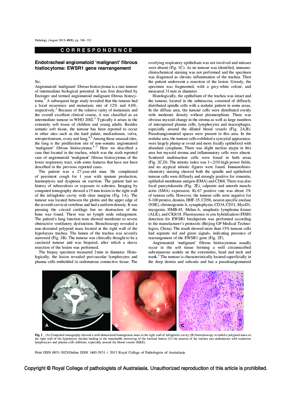 Endotracheal angiomatoid 'malignant' fibrous histiocytoma: EWSR1 gene rearrangement