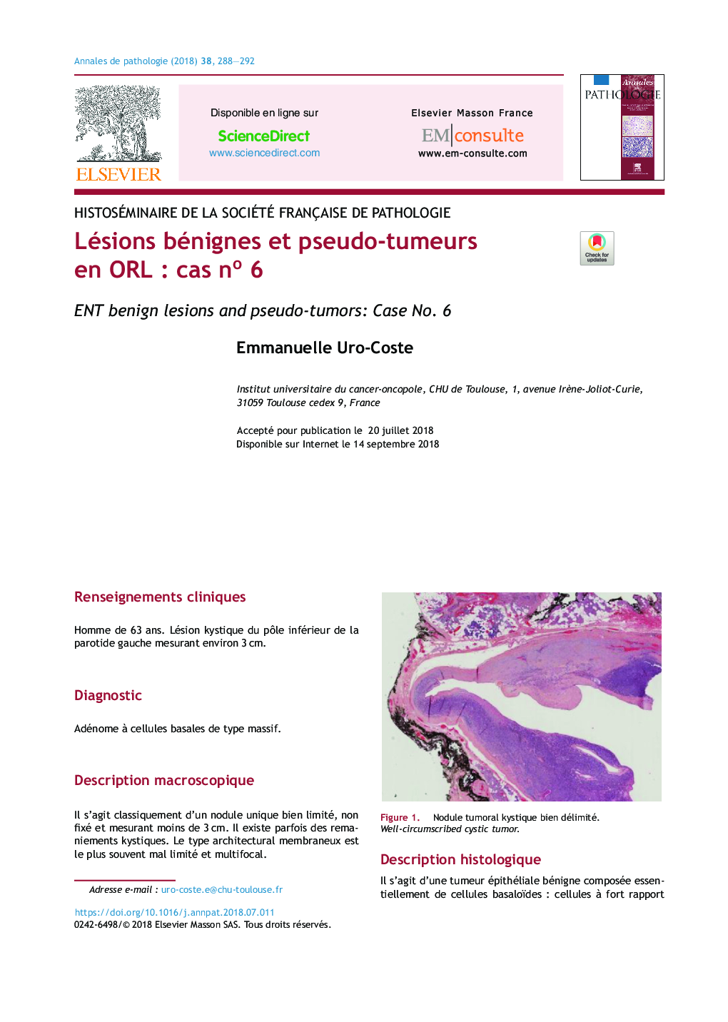 Lésions bénignes et pseudo-tumeurs en ORLÂ : cas noÂ 6