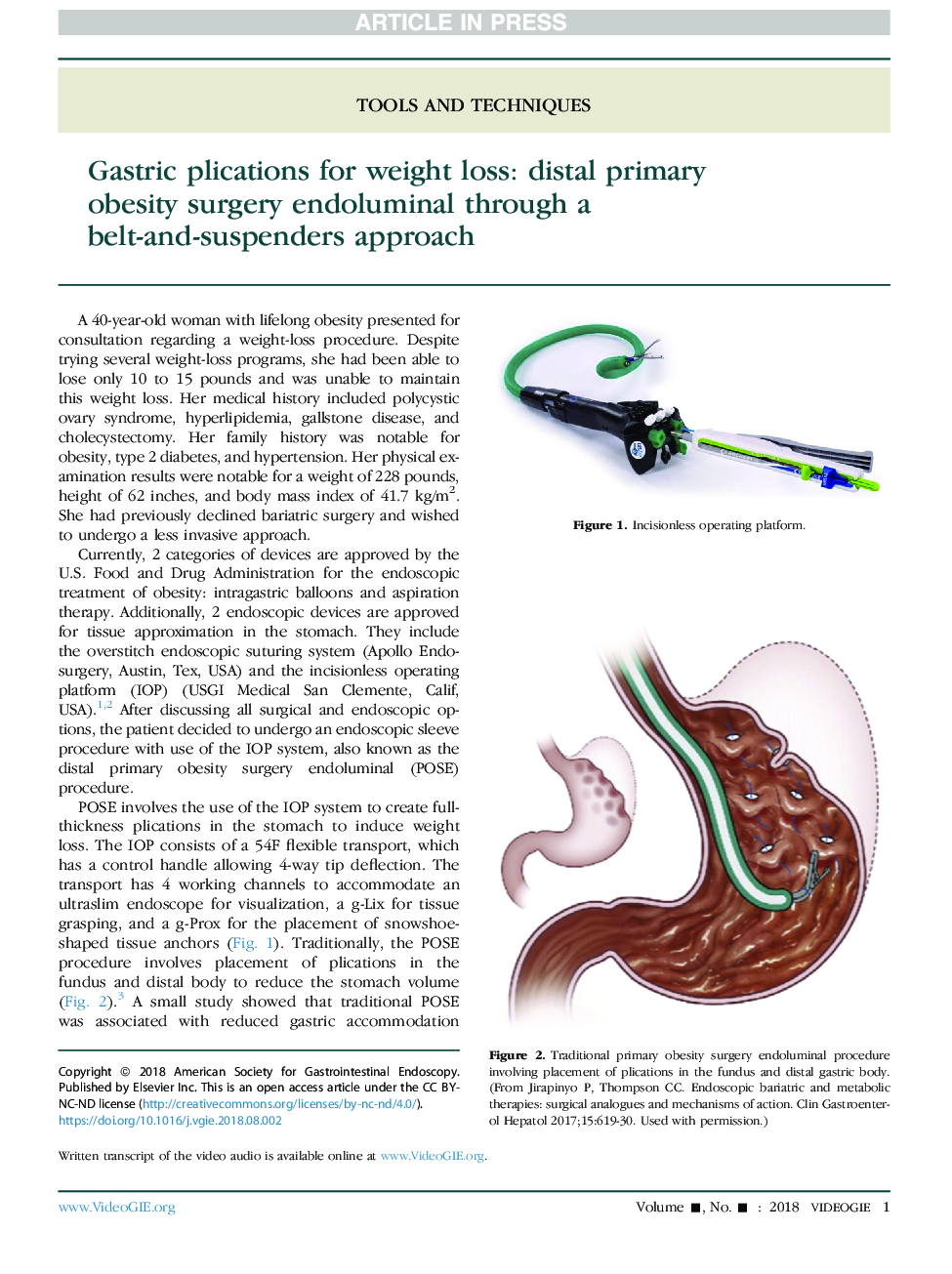 Gastric plications for weight loss: distal primary obesityÂ surgeryÂ endoluminal through a belt-and-suspenders approach