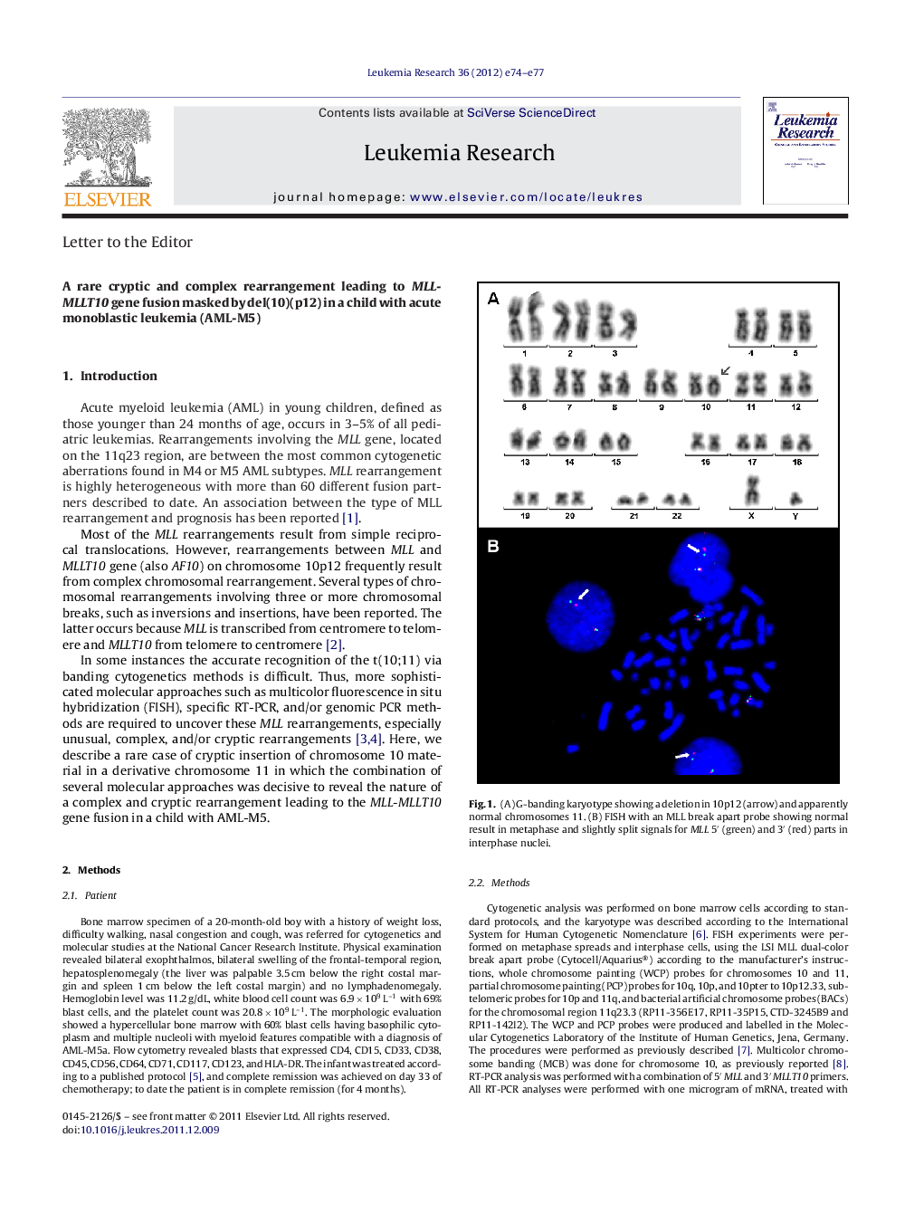 A rare cryptic and complex rearrangement leading to MLL-MLLT10 gene fusion masked by del(10)(p12) in a child with acute monoblastic leukemia (AML-M5)