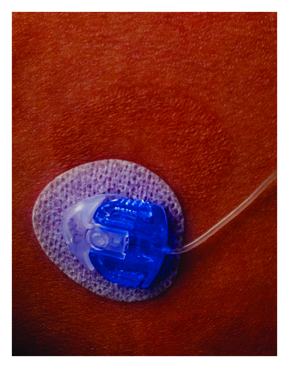 Continuous Subcutaneous Insulin Infusion for Managing Diabetes: Women's Health Implications