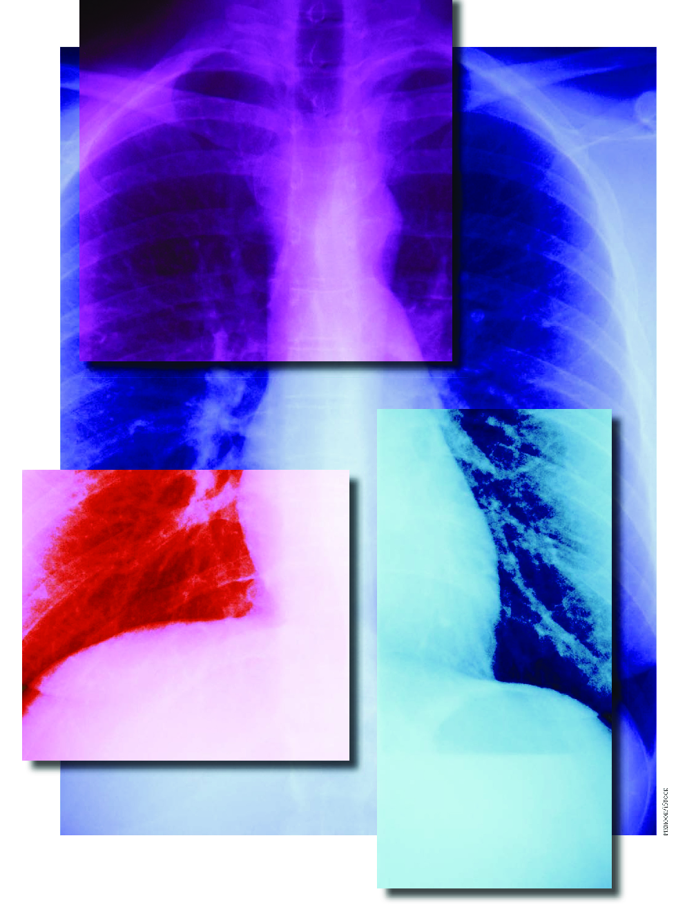 عکس صفحه اول مقاله: Interpretación de la radiografÃa de tórax: algo más que blanco y negro Interpretación de la radiografÃa de tórax: algo más que blanco y negro