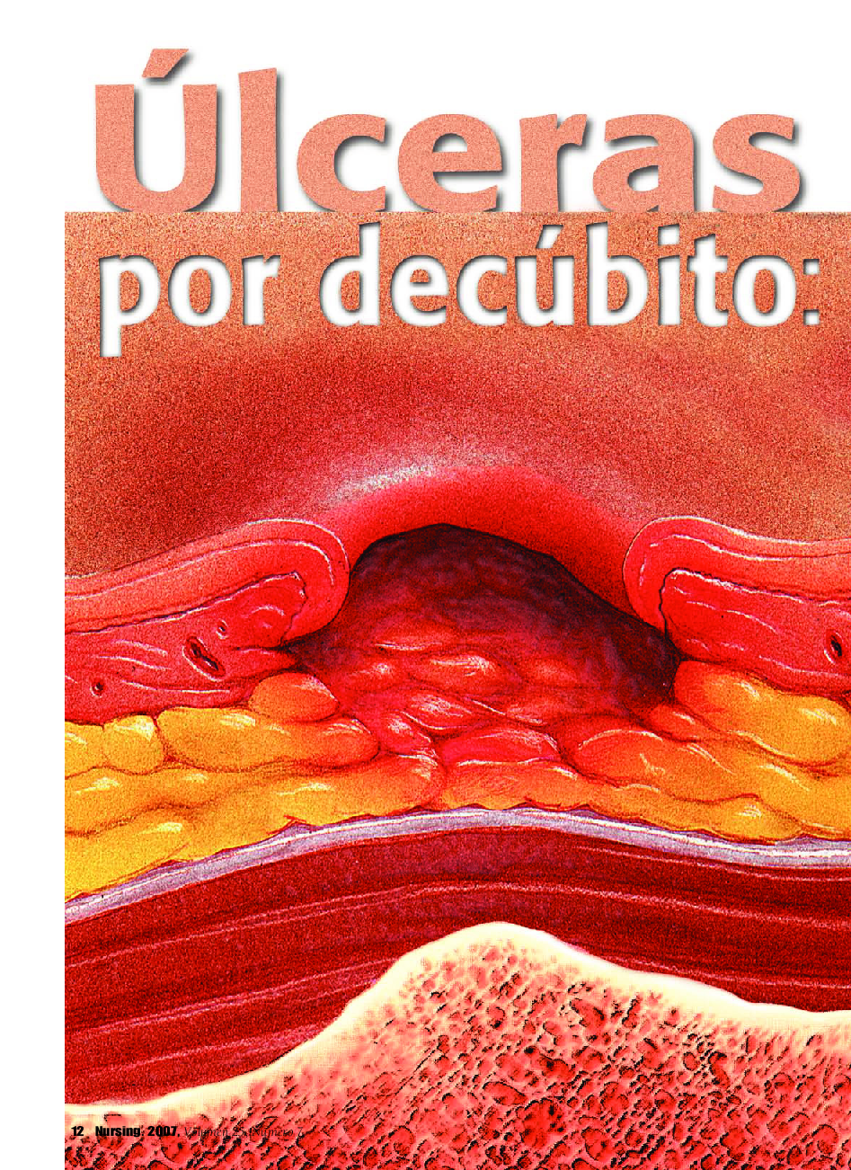 عکس صفحه اول مقاله: Ãlceras por decúbito: una concienciación renovada Ãlceras por decúbito: una concienciación renovada