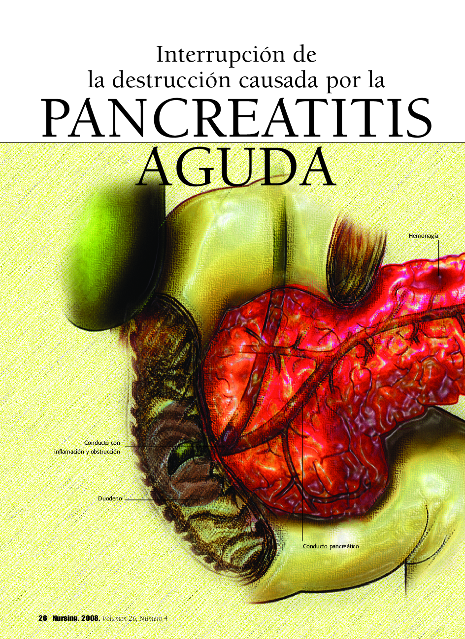 عکس صفحه اول مقاله: Interrupción de la destrucción causada por la Pancreatitis Aguda Interrupción de la destrucción causada por la Pancreatitis Aguda