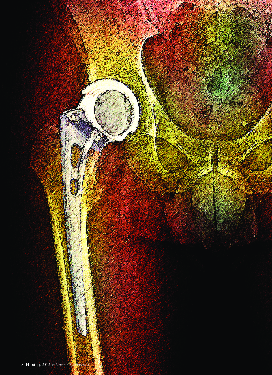 عکس صفحه اول مقاله: Hemiartroplastia de cadera Hemiartroplastia de cadera