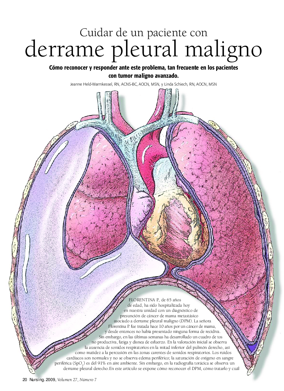 عکس صفحه اول مقاله: Cuidar de un paciente con derrame pleural maligno Cuidar de un paciente con derrame pleural maligno