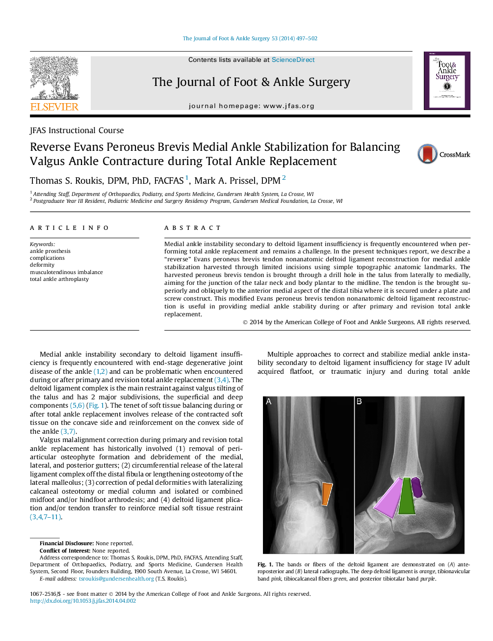 Reverse Evans Peroneus Brevis Medial Ankle Stabilization for Balancing Valgus Ankle Contracture during Total Ankle Replacement