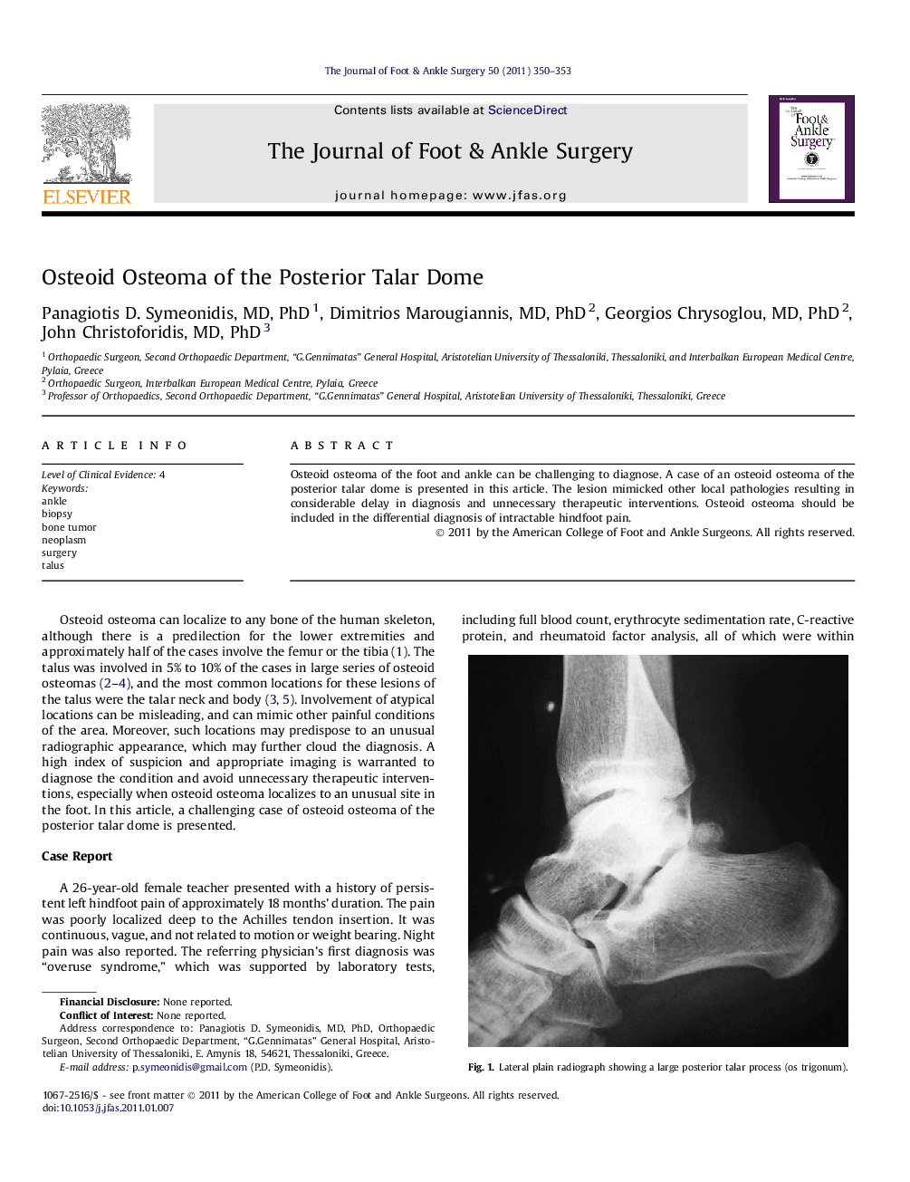 Osteoid Osteoma of the Posterior Talar Dome 