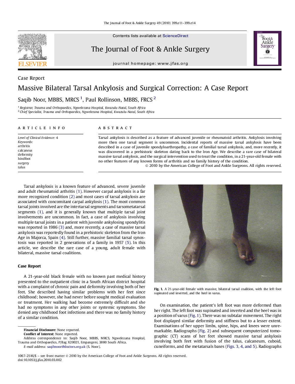 Massive Bilateral Tarsal Ankylosis and Surgical Correction: A Case Report