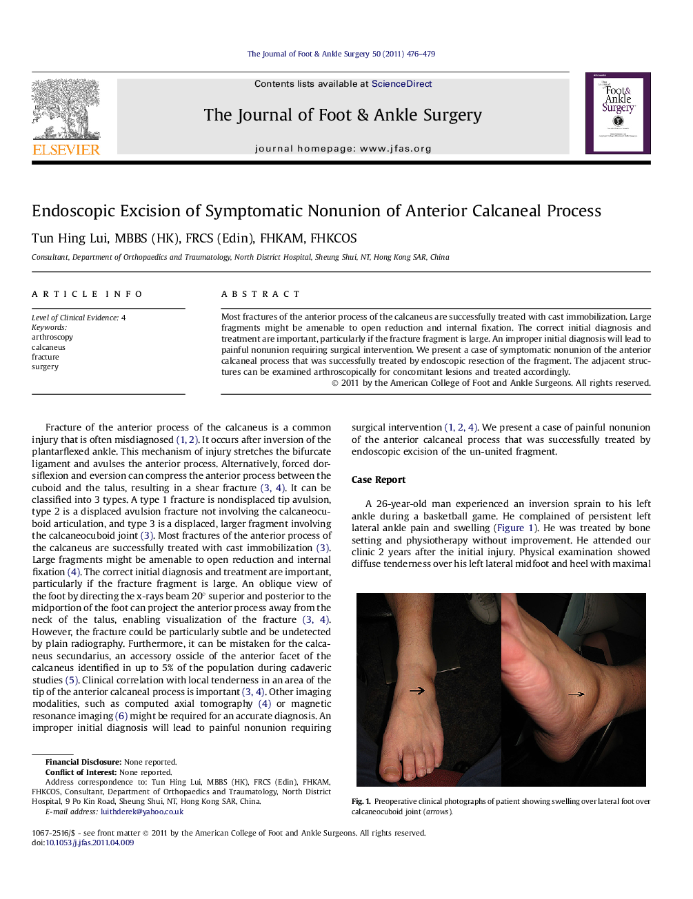 Endoscopic Excision of Symptomatic Nonunion of Anterior Calcaneal Process 