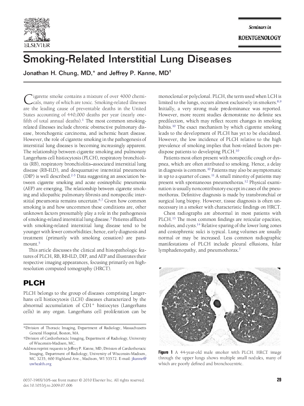 Smoking-Related Interstitial Lung Diseases