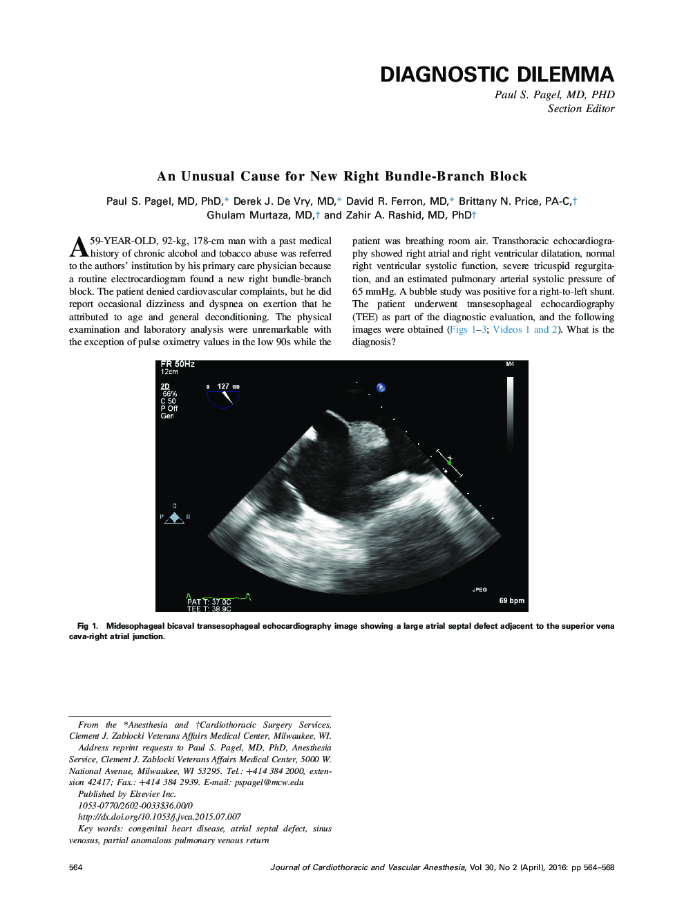 An Unusual Cause for New Right Bundle-Branch Block