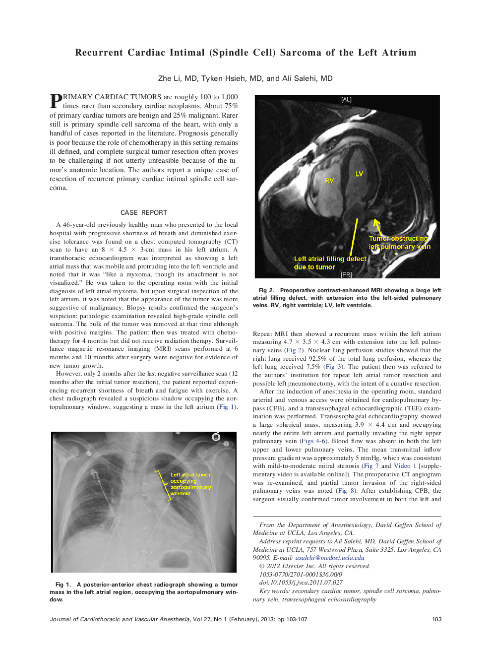 Recurrent Cardiac Intimal (Spindle Cell) Sarcoma of the Left Atrium