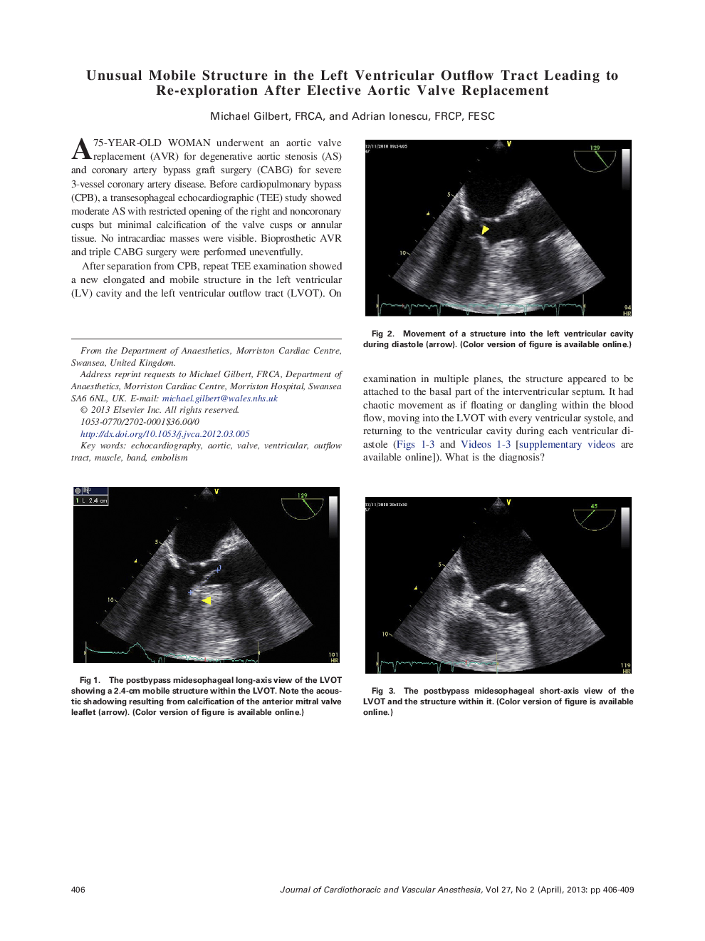 Unusual Mobile Structure in the Left Ventricular Outflow Tract Leading to Re-exploration After Elective Aortic Valve Replacement