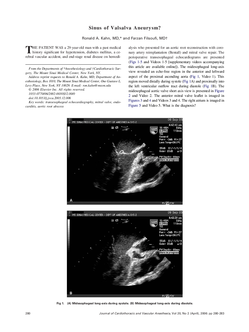 Sinus of Valsalva Aneurysm?