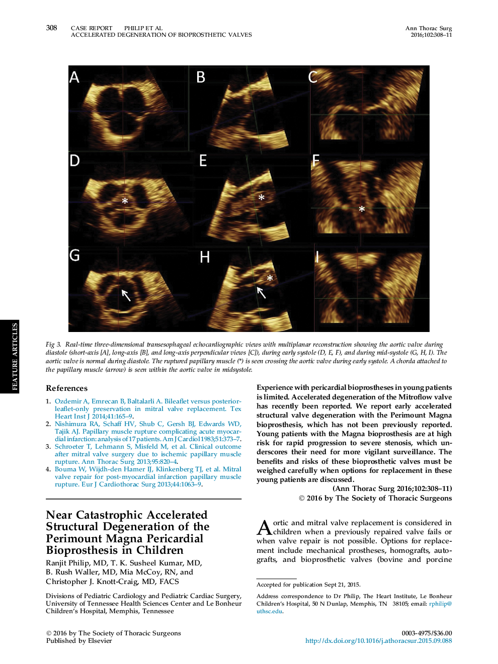 Near Catastrophic Accelerated Structural Degeneration of the Perimount Magna Pericardial Bioprosthesis in Children