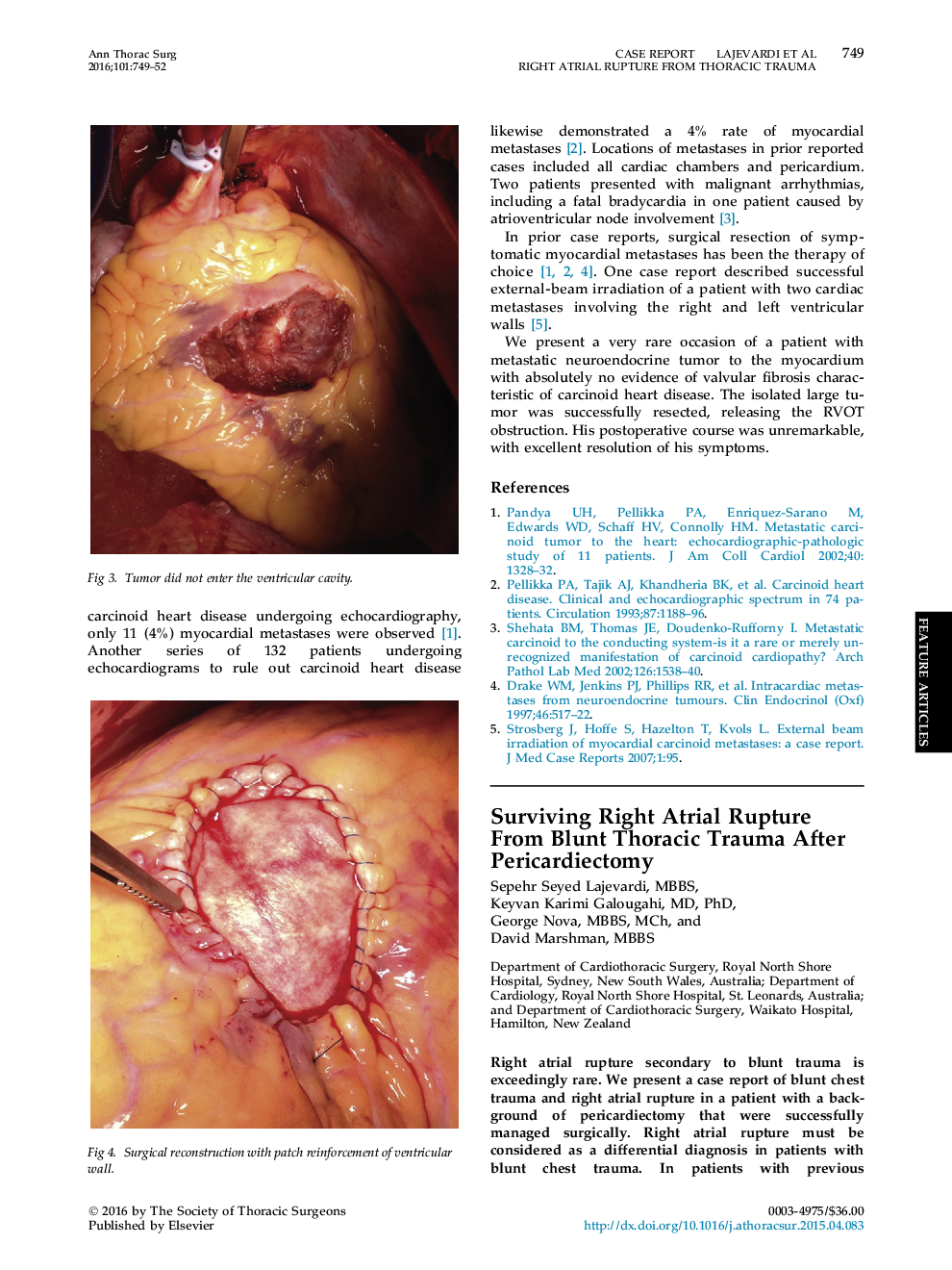 Surviving Right Atrial Rupture From Blunt Thoracic Trauma After Pericardiectomy