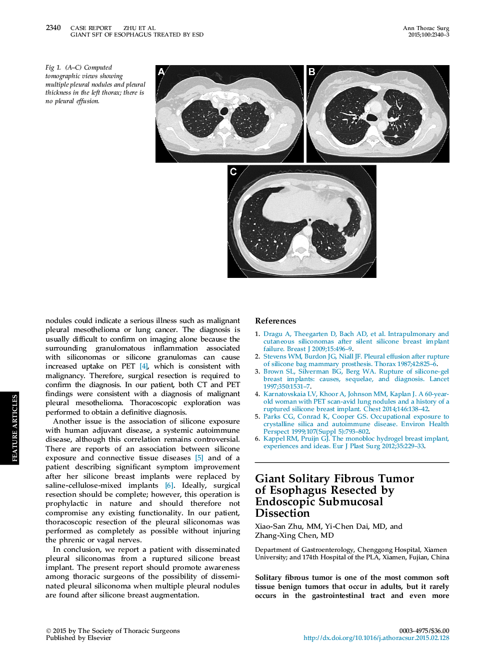 Giant Solitary Fibrous Tumor ofÂ Esophagus Resected by Endoscopic Submucosal Dissection