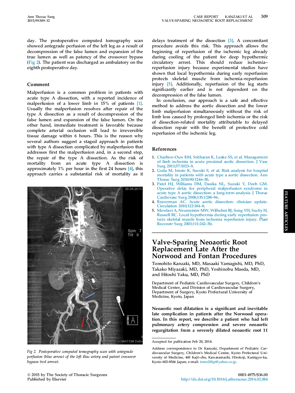 Valve-Sparing Neoaortic Root Replacement Late After the Norwood and Fontan Procedures