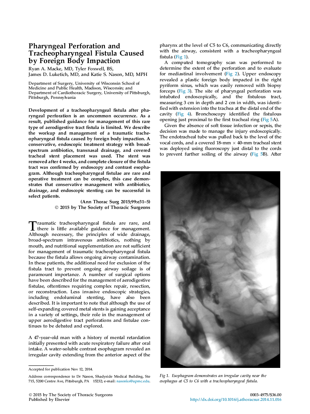 Pharyngeal Perforation and Tracheopharyngeal Fistula Caused by Foreign Body Impaction