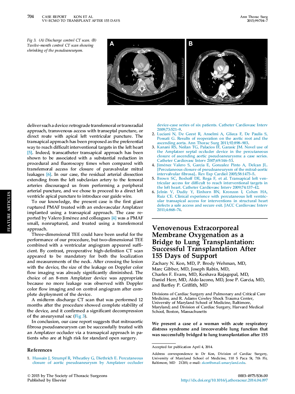Venovenous Extracorporeal Membrane Oxygenation as a Bridge to Lung Transplantation: Successful Transplantation After 155 Days ofÂ Support