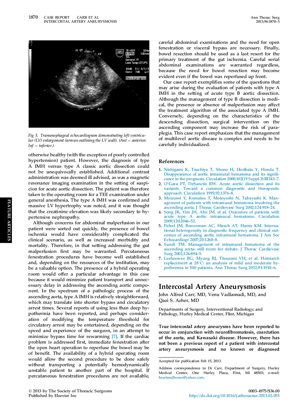 Intercostal Artery Aneurysmosis