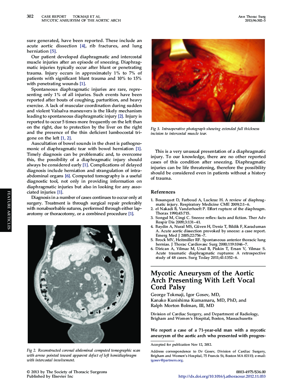 Mycotic Aneurysm of the Aortic Arch Presenting With Left Vocal Cord Palsy