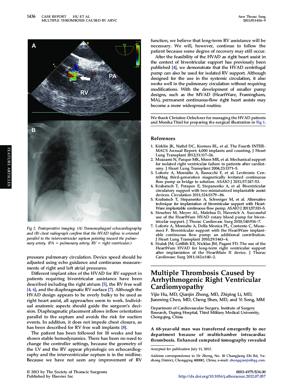 Multiple Thrombosis Caused by Arrhythmogenic Right Ventricular Cardiomyopathy