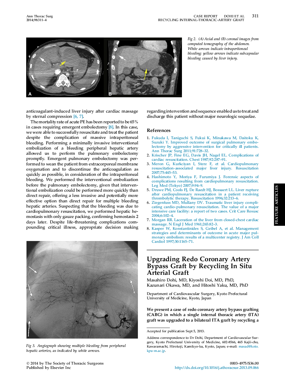 Upgrading Redo Coronary Artery Bypass Graft by Recycling In Situ Arterial Graft