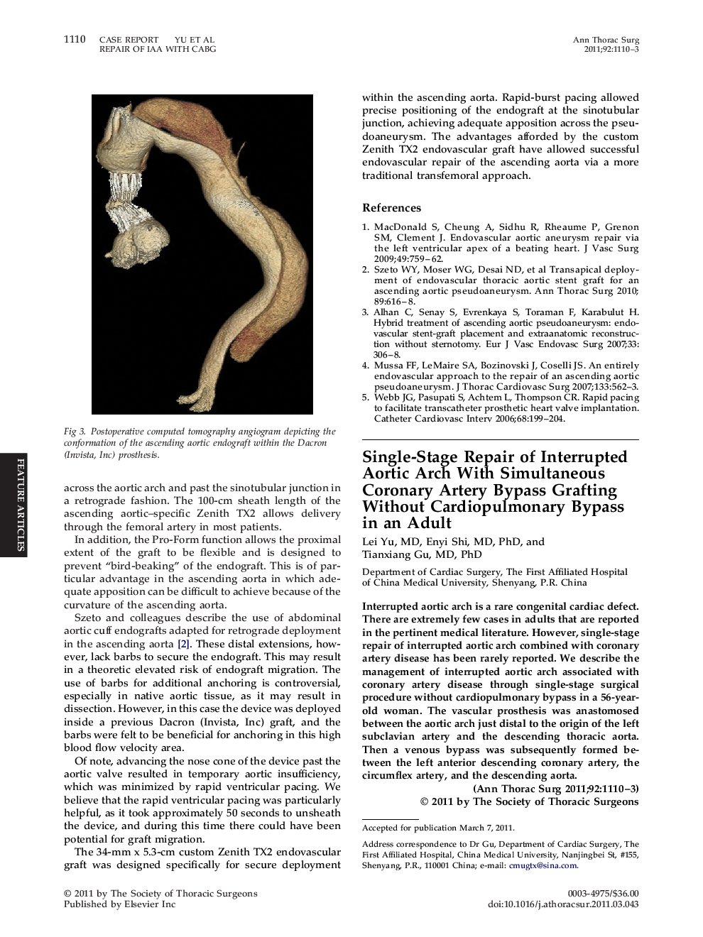 Single-Stage Repair of Interrupted Aortic Arch With Simultaneous Coronary Artery Bypass Grafting Without Cardiopulmonary Bypass in an Adult