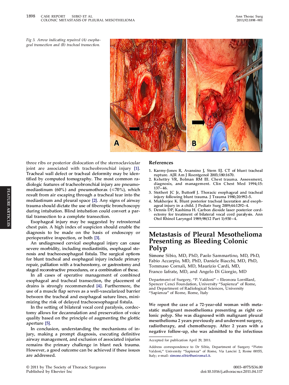Metastasis of Pleural Mesothelioma Presenting as Bleeding Colonic Polyp