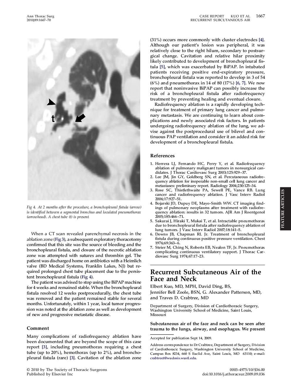 Recurrent Subcutaneous Air of the Face and Neck