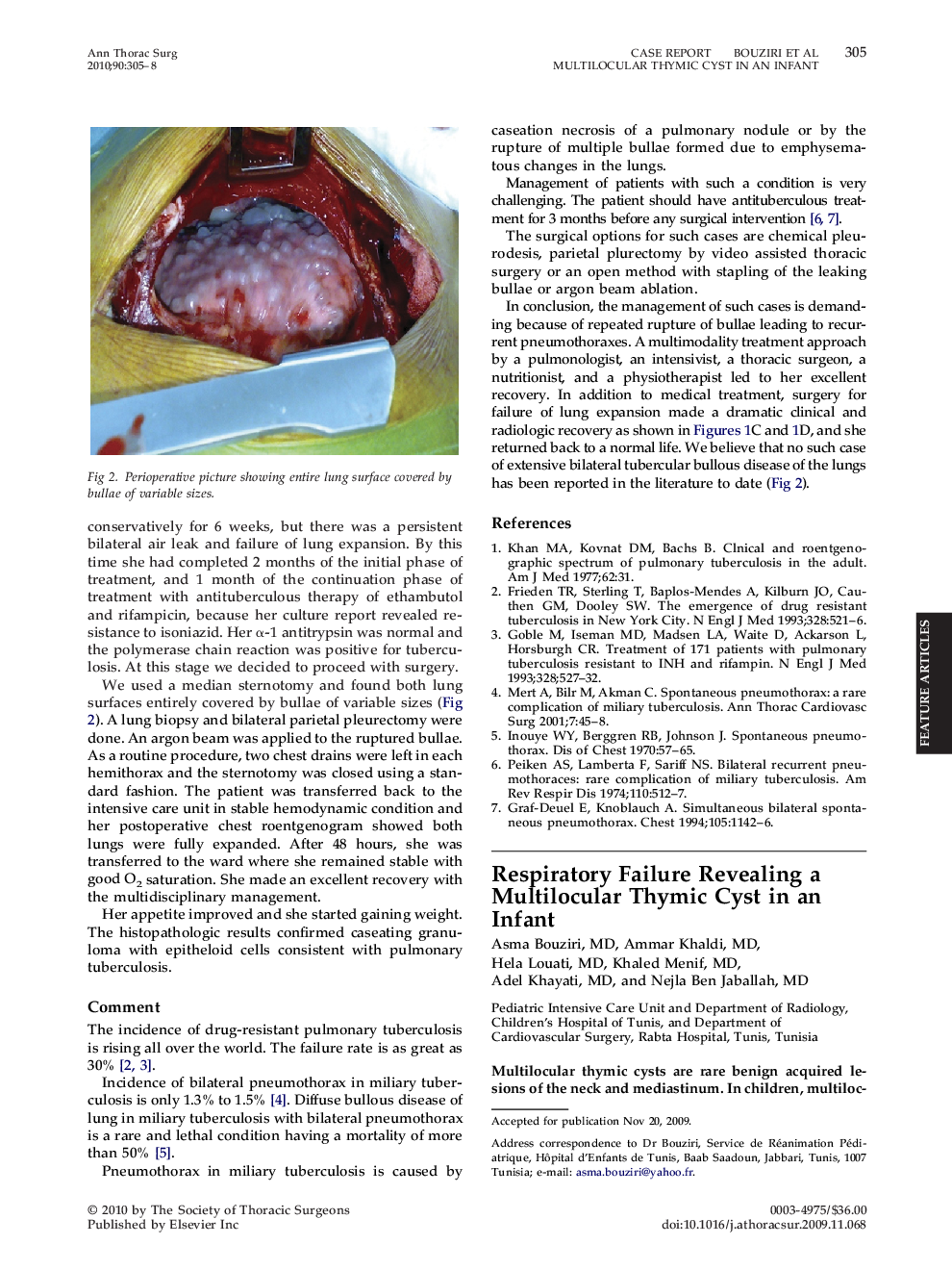 Respiratory Failure Revealing a Multilocular Thymic Cyst in an Infant