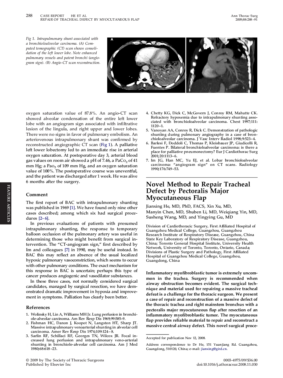 Novel Method to Repair Tracheal Defect by Pectoralis Major Myocutaneous Flap